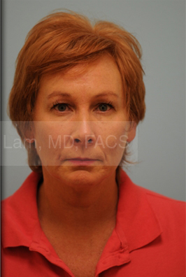 Lam facial plano