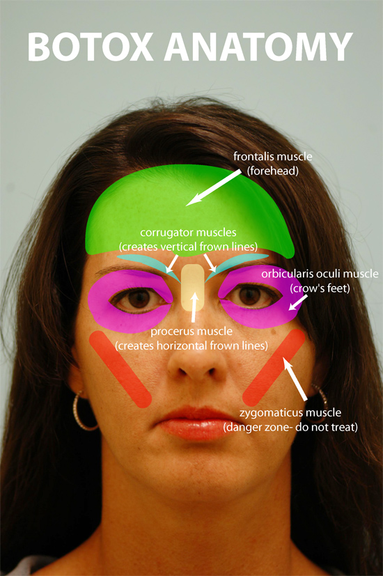 Botox discussion sans mean comments, please