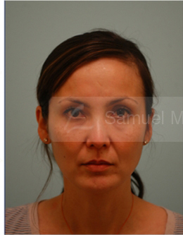 Primary Facial Fat Transfer