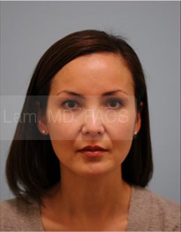 Primary Facial Fat Transfer