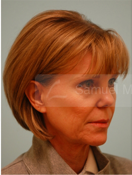 Primary Facial Fat Transfer