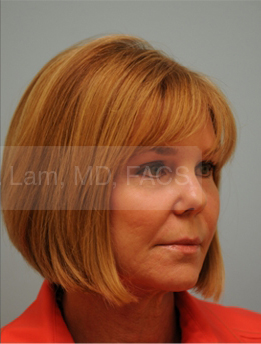 Primary Facial Fat Transfer