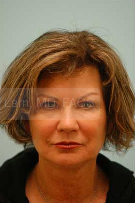 Primary Facial Fat Transfer