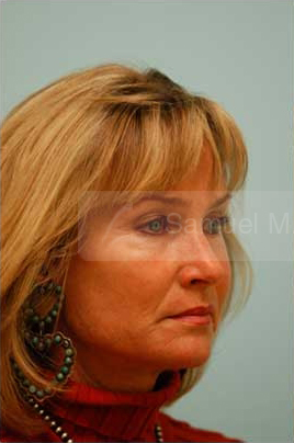 Primary Facial Fat Transfer