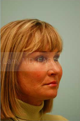Primary Facial Fat Transfer