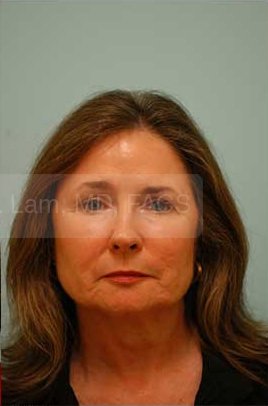 Primary Facial Fat Transfer