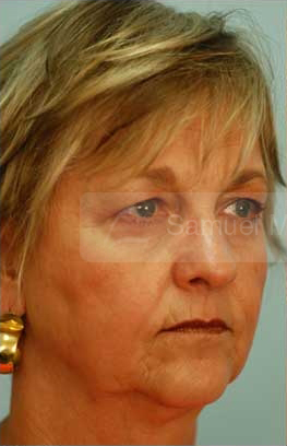Primary Facial Fat Transfer