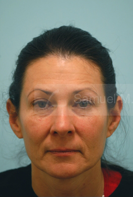 Primary Facial Fat Transfer