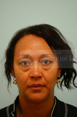 Primary Facial Fat Transfer