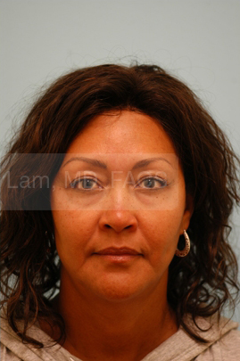 Primary Facial Fat Transfer