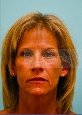 Primary Facial Fat Transfer