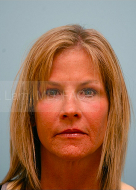 Primary Facial Fat Transfer