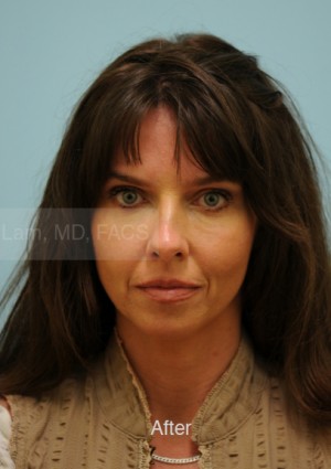 Primary Facial Fat Transfer