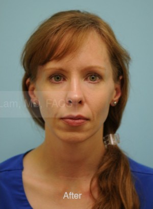Primary Facial Fat Transfer