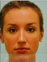 Rhinoplasty-Nose Job