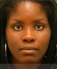 Rhinoplasty-Nose Job