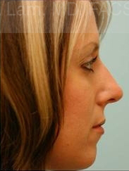Rhinoplasty-Nose Job