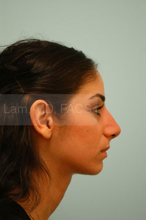 Rhinoplasty-Nose Job