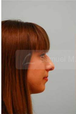 Rhinoplasty-Nose Job
