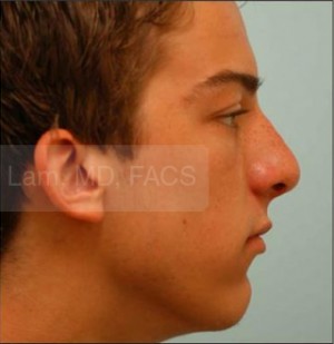 Rhinoplasty-Nose Job