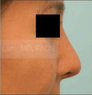 Rhinoplasty-Nose Job
