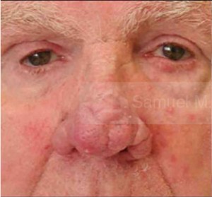 Rhinoplasty-Nose Job