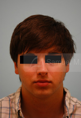 Rhinoplasty-Nose Job