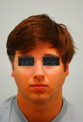 Rhinoplasty-Nose Job