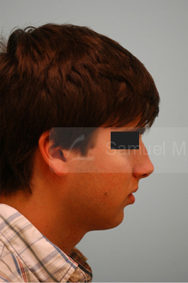 Rhinoplasty-Nose Job