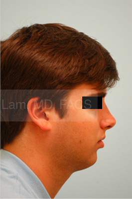 Rhinoplasty-Nose Job