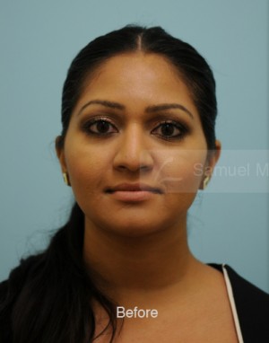 Rhinoplasty-Nose Job