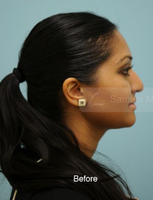 Rhinoplasty-Nose Job