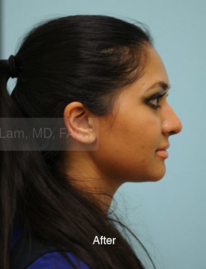 Rhinoplasty-Nose Job