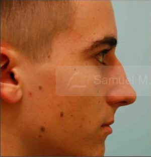 Revision/Corrective Rhinoplasty