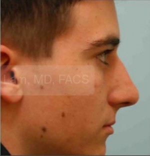 Revision/Corrective Rhinoplasty