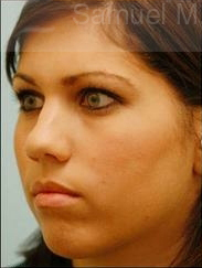 Revision/Corrective Rhinoplasty