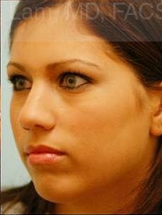 Revision/Corrective Rhinoplasty
