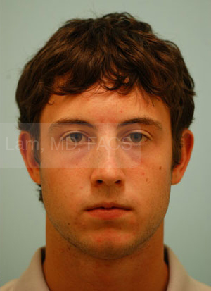 Revision/Corrective Rhinoplasty