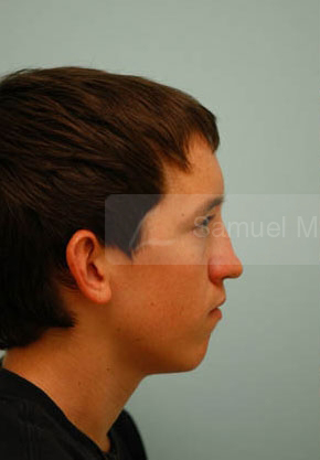 Revision/Corrective Rhinoplasty