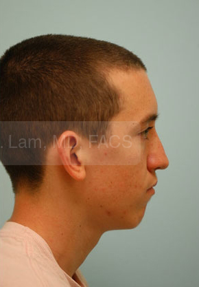 Revision/Corrective Rhinoplasty