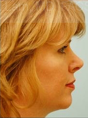 Revision/Corrective Rhinoplasty