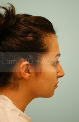 Revision/Corrective Rhinoplasty