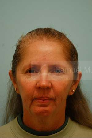 Otoplasty (Cosmetic Ear Reshaping)