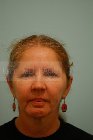 Otoplasty (Cosmetic Ear Reshaping)