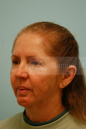 Otoplasty (Cosmetic Ear Reshaping)