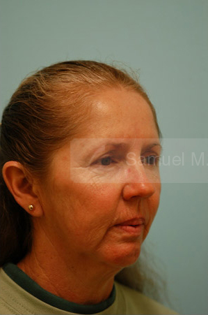 Otoplasty (Cosmetic Ear Reshaping)