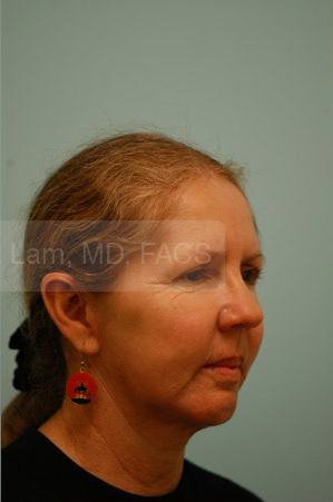 Otoplasty (Cosmetic Ear Reshaping)