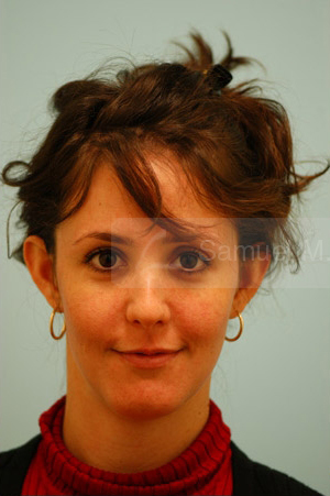 Otoplasty (Cosmetic Ear Reshaping)