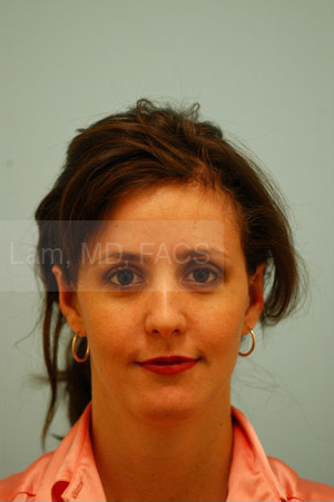Otoplasty (Cosmetic Ear Reshaping)