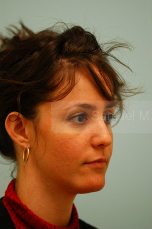 Otoplasty (Cosmetic Ear Reshaping)